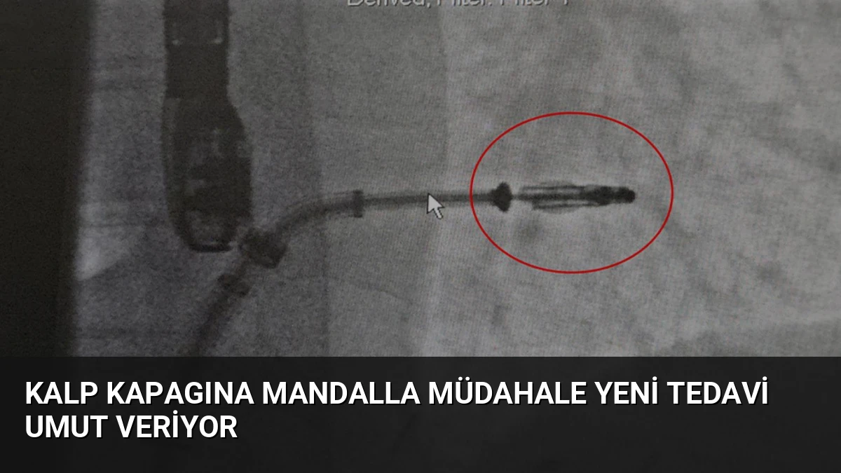 Kalp Kapagına Mandalla Müdahale Yeni Tedavi Umut Veriyor