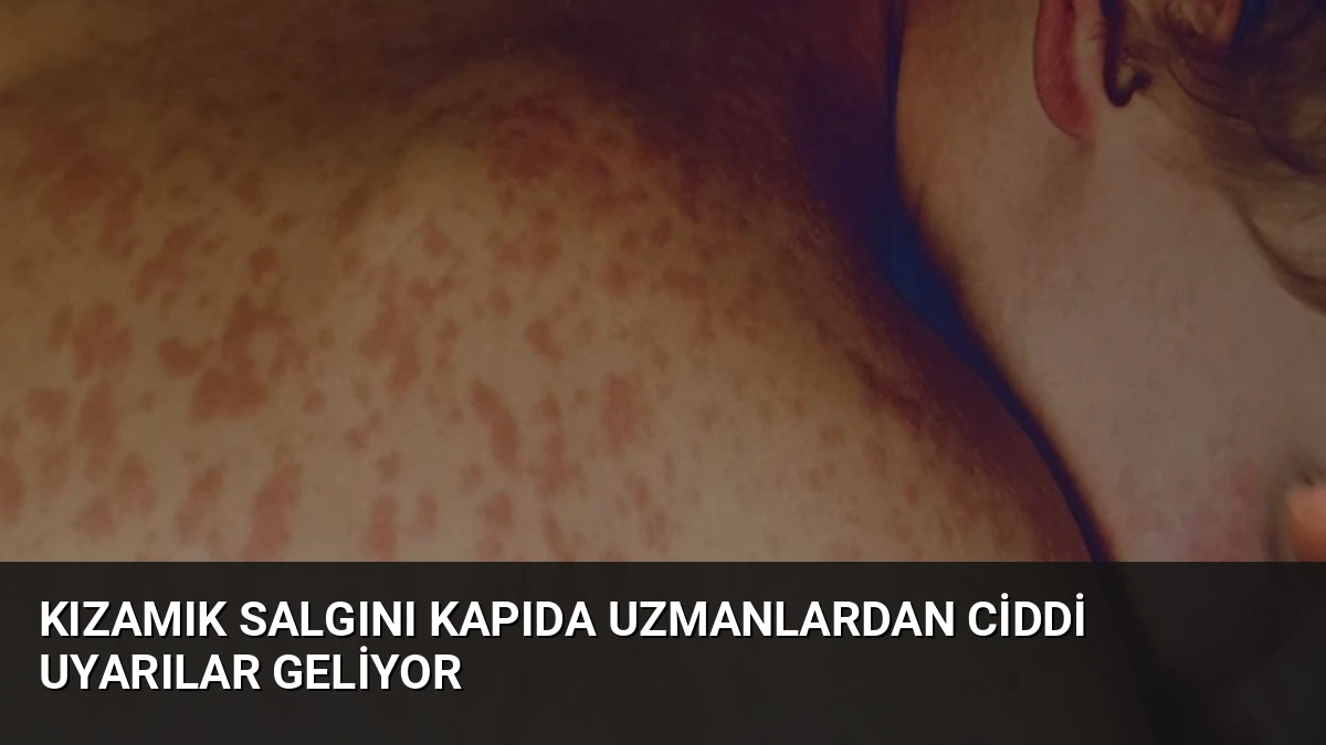 Kızamık Salgını Kapıda Uzmanlardan Ciddi Uyarılar Geliyor